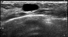 How does the age of a woman help us in the differentiation between a fibroadenoma and breast cancer? Breast Ultrasound