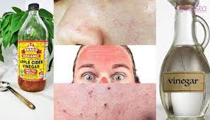 Jadi kamu lebih baik menggunakannya malam hari sebelum tidur, sehabis cuci muka ya. Cuka Sari Epal Mampu Memperbaiki Masalah Kulit Wajah Dan Badan Dengan 15 Kaedah Ini Hijabista