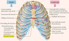 Source Imgur Com Rib Fracture Fracture Thoracic Cage