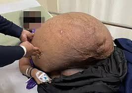 Abbie (19) er allergisk mot vann