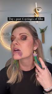 1 day post yearly filler touch , 6 syringes later…, Yes I have Bruising,  swelling, and tenderness , BUT, I have NO regrets! , I Love my chin! , My  favorite treatment combo to keep you looking Natural: ...