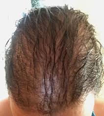 Some types may be accompanied by additional information, such as hair loss on the vertex of the scalp. Diffuse Hair Loss On The Frontal Scalp And Vertex Of The Scalp With Download Scientific Diagram