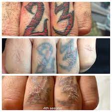 At best, tattoo removal cream might fade or lighten a tattoo. Laser Tattoo Removal Services In Naples Fl 239 431 5432