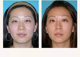 But they're all the rage in hollywood and social media right now; Asian Eyelids Dr Seung K Kim Palo Alto Plastic Surgeondr Seung K Kim Palo Alto Plastic Surgeon