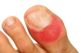 Image result for Paronychia feet