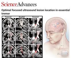Image result for Neurologic Lesion Localization