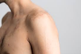 Shoulder blade pain may be a sign that your lifting form is incorrect, your posture is poor, or you are either too sedentary or too active. Shoulder Wikipedia