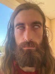 Fundraiser by Evan Morganstern : Help Seay Recover from Severe Brown  Recluse Spider Bite