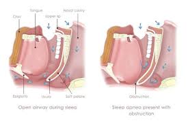 Image result for Sleep Apnea