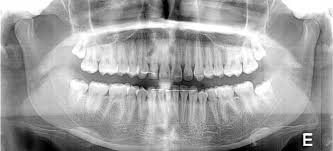 Radiologia Odontologica Raio X Dos Dentes Rx Oral Ou Boca