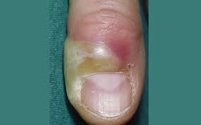 Image result for Paronychia feet