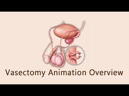Image result for Vasectomy