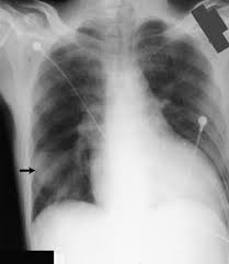 Other causes are complicated parapneumonic effusion. Pleural Effusion Pulmonary Disorders Msd Manual Professional Edition