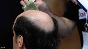 8 أسباب غير مألوفة لتساقط الشعر Hair Loss Reasons Hair Loss Hair