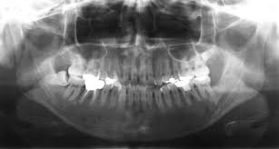 Most common malignant bone tumour in children. A Case Of Highly Suspected Small Cell Osteosarcoma In The Mandible Sciencedirect