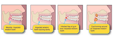 We did not find results for: Do I Need To Remove My Wisdom Tooth South Perth Dental Excellence