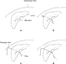 Maybe you would like to learn more about one of these? Retrograde Installation Of Percutaneous Transhepatic Negative Pressure Biliary Drainage Stabilizes Pancreaticojejunostomy After Pancreaticoduodenectomy A Retrospective Cohort Study World Journal Of Surgical Oncology Full Text