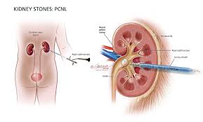Human Kidney Stones Kidney Stones Urology Care Foundation Diagram
