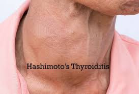 Image result for Thyroiditis