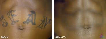 Tattoo removal durham how bad does tattoo removal hurt how to. Laser Tattoo Removal Wake Health Medical Group Raleigh Nc