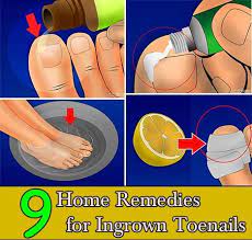 9 Home Remedies For Ingrown Toenails Foot Remedies Ingrown Toe Nail Swollen Feet Remedy