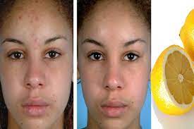 Lemon Acne Scars Before And After Benefits Methods And Remedies