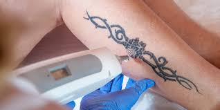 Before the advent of laser removal machines, people went to side effects: The Science Behind Laser Tattoo Removal Dr Pimple Popper
