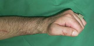 Maybe you would like to learn more about one of these? Tenodese Des Daumenendgelenks Mit Geteilter Flexor Pollicis Longus Sehne Springerlink