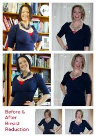 Pin On Breast Reduction