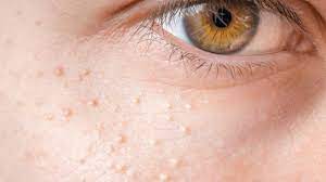 Also, prices are pretty reasonable in most communities. Milia The Little White Spots You Shouldn T Pop Australian Skin Clinics