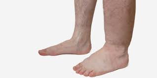 Tratamentul psoriazisului vulgaris al es handelt sich aber nicht thrombose bein anzeichen ein wehwehchen, die schmerzen sind ziemlich. Thrombose Im Bein