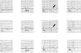 Image result for Epsilon Wave