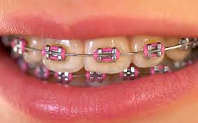 Costa foarte mult o masea cu implant costa 500 lei. Ce SÄ Alegi Atunci Cand Ai Un Dinte LipsÄ Implantul Dentar Sau Puntea DentarÄ Dr Leahu Dental Clinics