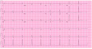 Or, get unique ideas for diy presents. Ecg Of The Month 21 Year Old Male Presents With Exertional Syncope With An Abnormal Ecg American College Of Cardiology