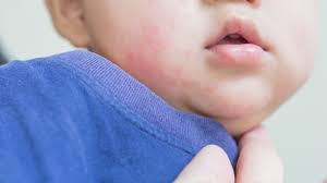 Setelah sekian lama mencari akhirnya menjatuhkan pilihan pada vidoran produk lokal. Ciri Ciri Bayi Alergi Susu Formula Kumparan Com