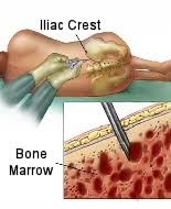 Image result for Bone Marrow Exam
