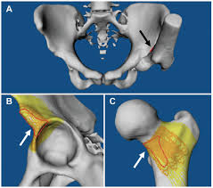 Image result for Femoral Retroversion