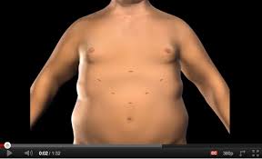Gastric Sleeve Surgery Cost Brisbane Australia Lap Surgery Brisbanedr William Braun