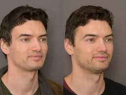 UK's Leading Rhinoplasty Surgeon │ Charles East