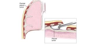 This thin layer of tissue is called the mesothelium. Pleurectomy And Decortication