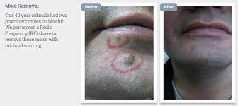 The strongest risk factor for developing skin cancer is ultraviolet (uv) ray exposure, typically from the sun. What You Need To Know About Mole Removal Me Clinic