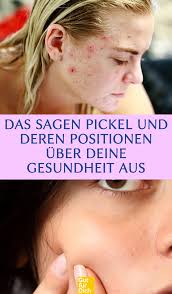 Um pickel unter der haut zu vermeiden, solltest du unbedingt auf eine ausgewogene ernährung achten. 6 Verschiedene Pickelarten Und Was Sie Zu Bedeuten Haben Pickel Unter Der Haut Pickel Gesicht Mapping