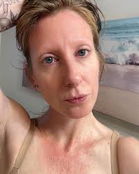 The debilitating lupus rash…. No filter. Nothing like soothing the itch and  burn and rubbing in olive oil . Olive oil has many potential health  benefits, including: Reduced inflammation Olive oil contains