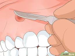 كيفية التخلص من خراج اللثة 10 خطوات صور توضيحية Wikihow