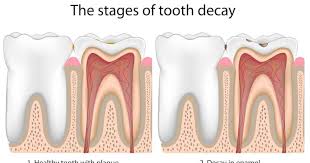 Root canal surgery has come quite a long way over the years. 10 Tips To Prevent Root Canal Las Vegas Nevada Dentistry Braces