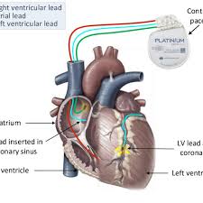 Patient selection, device programming, and clinical benefits are discussed. Biventricular Pacemaker Icd 10 Pcs