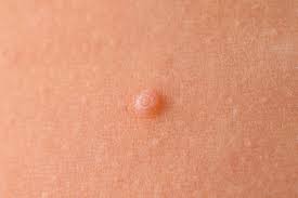 Como Reconocer Una Infeccion Por Molusco Contagioso O Vph