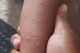 Image result for scabies human children