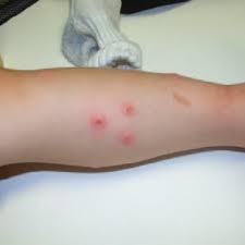 Image result for Papular urticaria