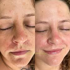 ya girl has had two Cult Facial ™ ——at home skin regimen was highly  microbiome focused. first i worked